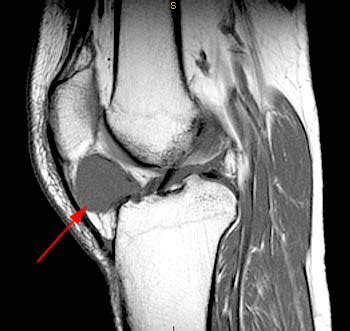 Radiology Pearls Infrapatellar Hoffa S Fat Pad Ganglion Cyst