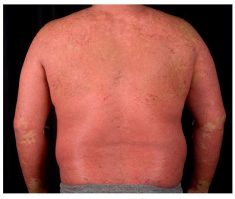 IJMS Free Full Text Psoriasis Pathogenesis And Treatment