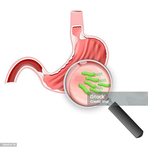 Helicobacter Pylori Stomach With Peptic Ulcer Disease And Magnifying Glass Stock Illustration ...