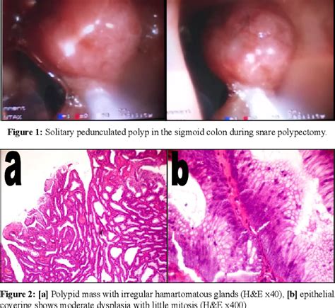 Figure 2 From Hamartoma Adenoma Carcinoma Sequence In A Solitary Peutz