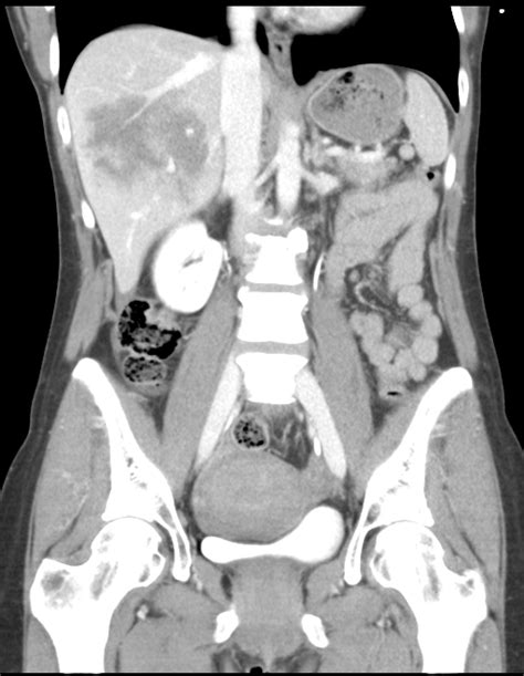 Liver Laceration Aast Grade V Image