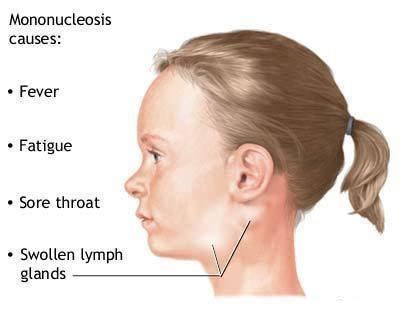 Mono Symptoms – Medical Symptoms Guide