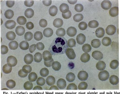 Figure 1 from The May-Hegglin anomaly: platelet function, ultrastructure and chromosome studies ...