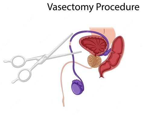 vasectomy-procedure | Patient Information Corner