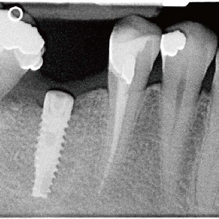 Post-treatment radiograph after second molar extraction. | Download Scientific Diagram