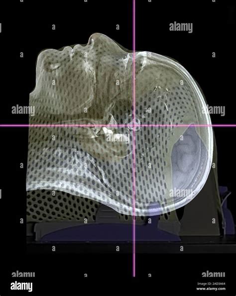 Tumor cerebral tratamiento de radioterapia 3D tomografía axial