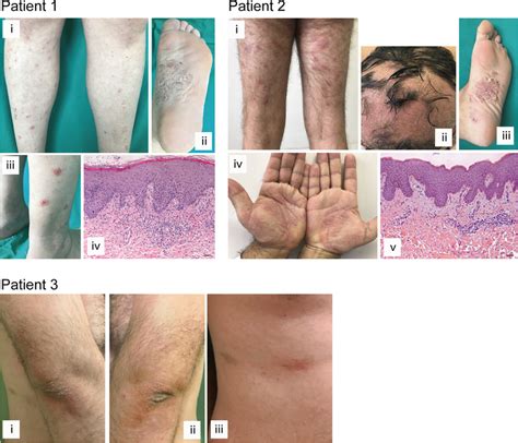 Clinical And Histological Presentation Of Paradoxical Psoriasis Induced