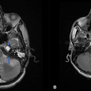 T2W axial images show hyperintense lesions in the left petrous ...