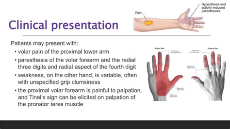 Pronator Teres Syndrome Pronator Syndrome Pptx