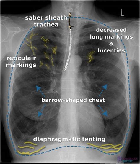 Chest X Ray