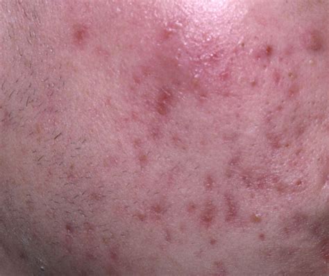 Acne Vulgaris Icd 10 L70 Online Consultation Ai Dermatologist