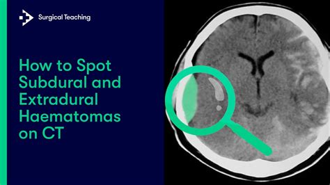 Extradural Vs Subdural Haematomas How Do We Diagnose Them On CT