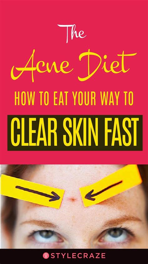 Anti Acne Diet What To Eat For Clearer And Healthier Skin Acne Diet