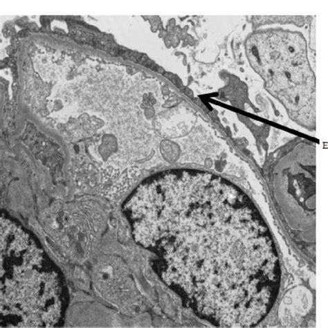 Electron Micrograph Of Renal Biopsy Showing Glomerulus With Effacement