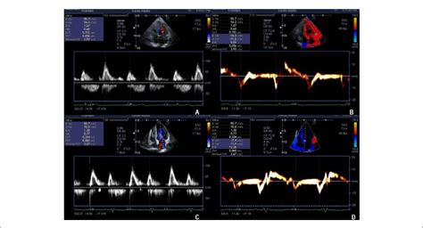 SciELO Brasil Evaluation Of Left Ventricular Diastolic Function By