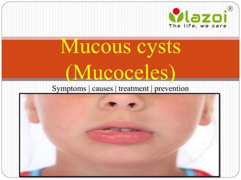 Mucous Cysts Mucoceles Symptoms Causes Treatment And Preventions Ppt