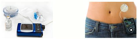 Помпа для диабетиков - что это, показания и правила использования