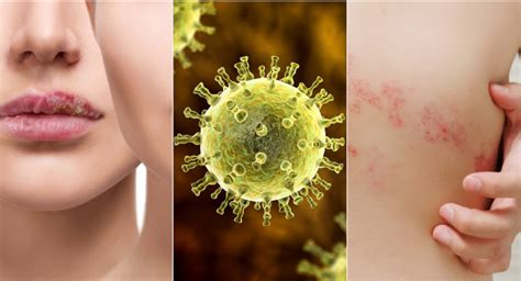 Herpes und Gürtelrose begleitend naturheilkundlich behandeln