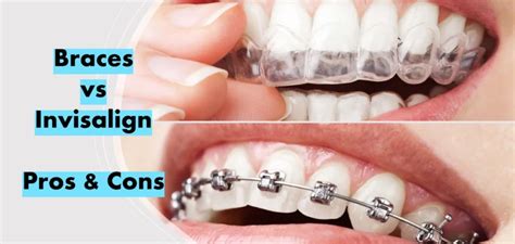 Should I Get Braces Or Invisalign? Braces vs Invisalign - Buzztify