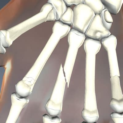 Hand Fractures Types