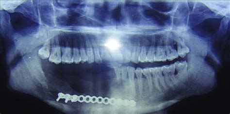 Orthopantomograph Showing Complete Integration Of The Graft After Two