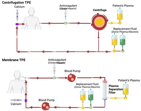 Therapeutic Plasma Exchange: An Interview – AJKD Blog