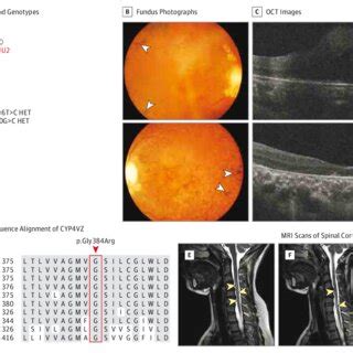 Clinical Phenotypes And FLVCR1 Mutations Identified In Patient RH13 II