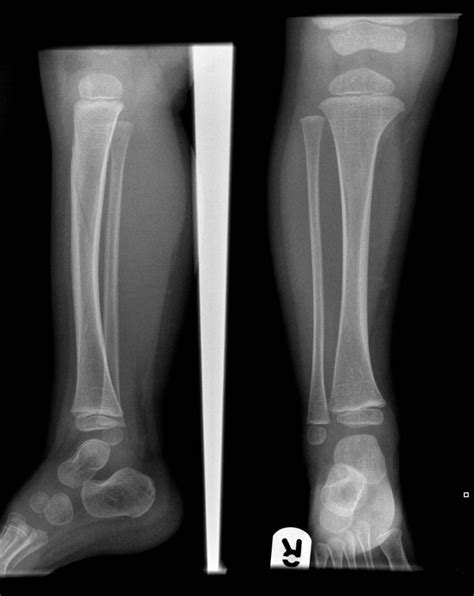 Toddler Fracture Buyxraysonline