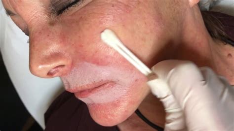 Rejuvenation Of Perioral Area With Trichloroacetic Acid TCA Acne