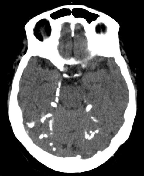 Tentorium Cerebelli Calcifications Radiology Case