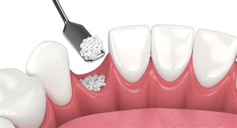 When Do You Need A Bone Graft For Dental Implants