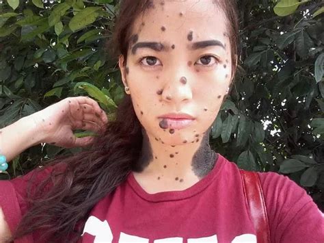 Woman Relentlessly Bullied For Mole Covered Face And Cruelly Branded A