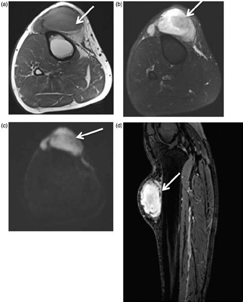 Schwannoma A 39 Year Old Man With Palpable Painful Anterior Leg Mass Download Scientific