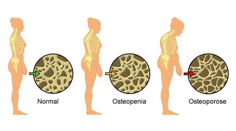 Qual A Diferen A Entre Osteopenia E Osteoporose