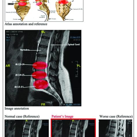 Revised design of the MRI lumbar spine report. | Download Scientific Diagram