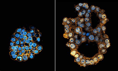 Base Editing In Organoids Opens New Doors For Cancer Research