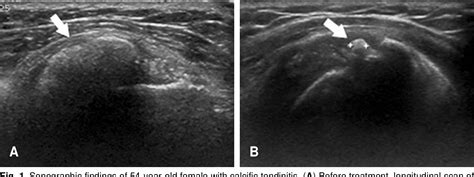 Pdf Ultrasonography Guided Multiple Needling For Calcific Tendinitis