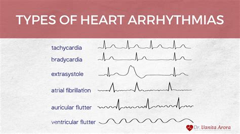 Types Of Rhythm In Heart Discount