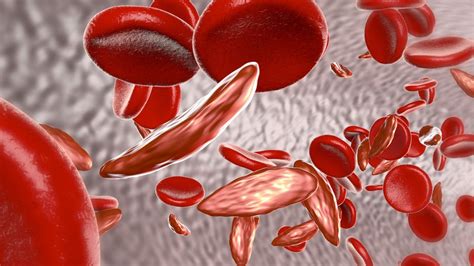 Crispr Gene Editing Used To Edit Out Sickle Cell Mutation Iflscience