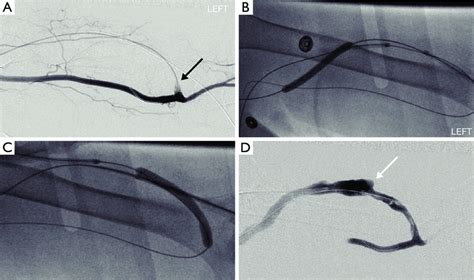 Pharmaco Mechanical Thrombectomy Of Clotted Brachiocephalic Avf A