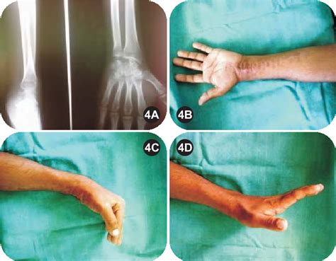 Figure From Kienbocks Disease Treated With Interposition