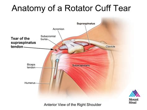 The Rotator Cuff Tear Rtc — Champion Performance And Physical Therapy