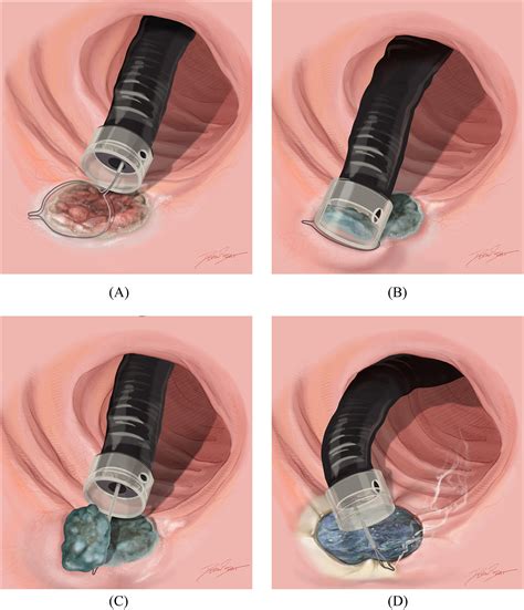 Distal Cap Assisted Endoscopic Mucosal Resection For Non Lifting