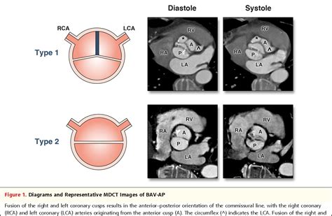 Figure 1 From Focus Issue Frontiers In Heart Valve Imagingoriginal Researchassociation Between