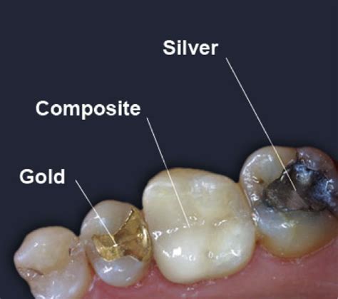 Tooth Fillings