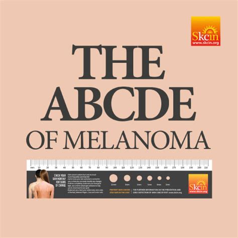 The ABCDE of Melanoma Method