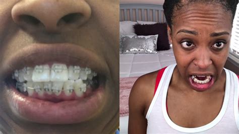 Adult Braces Before And After