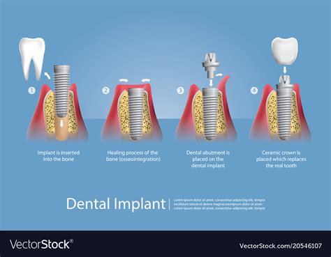 Human Teeth And Dental Implant Royalty Free Vector Image