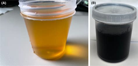 (A, B): Light yellow urine sample at time 0 (A); black urine after ...