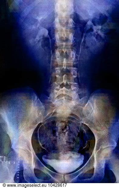 X Ray Of The Pelvis And Lower Back Of A 25 Years Old Woman Light